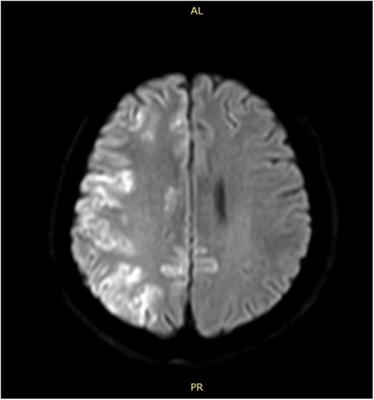 Case report: Cerebral artery air embolism during CT-guided lung nodule resection in hybrid theater